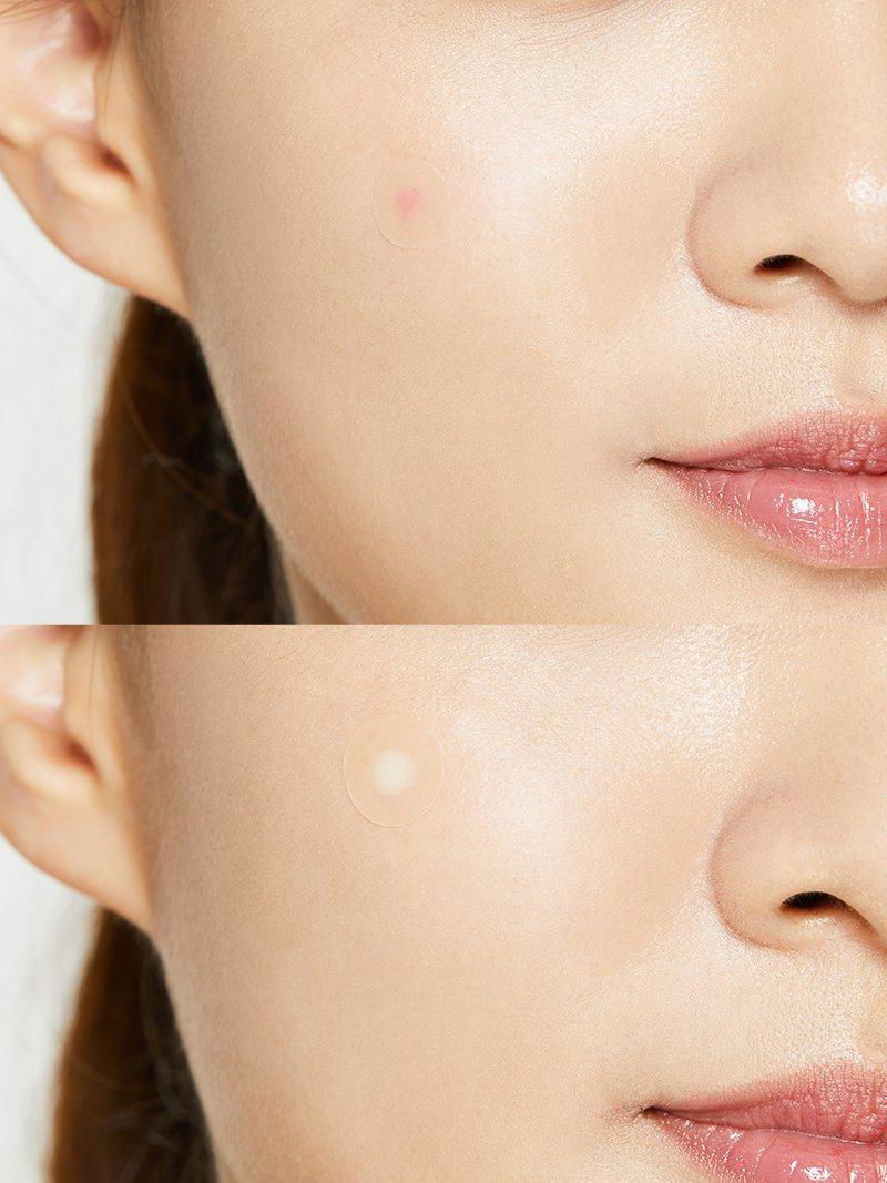 COSRX Acne Pimple Master Patch – 24 Patches - Miessential