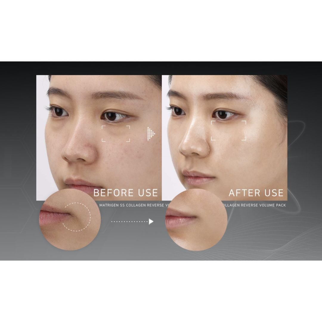 Matrigen SS Collagen Reverse Volume Pack (Wholesale) MiessentialStore
